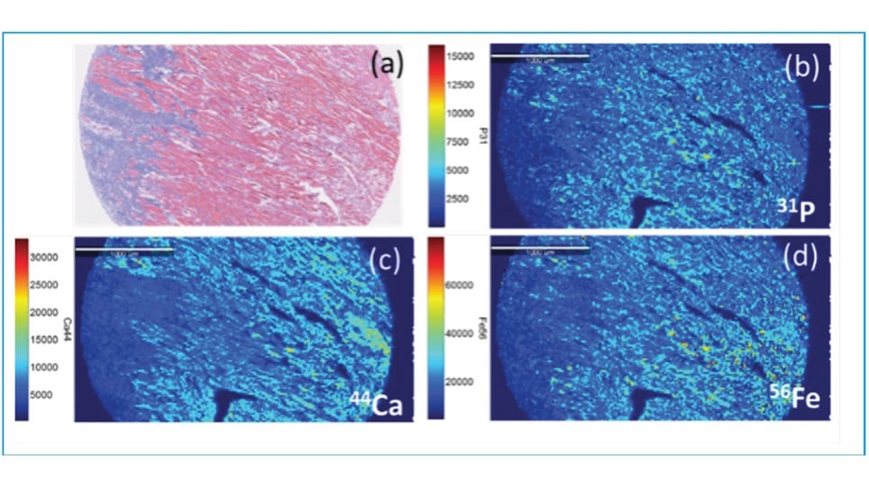 Azan staining of heart sample showing diseased area in blue. Distribution of phosphorus-31, calcium-44, and iron-56 obtained by LA-ICP-MS. 